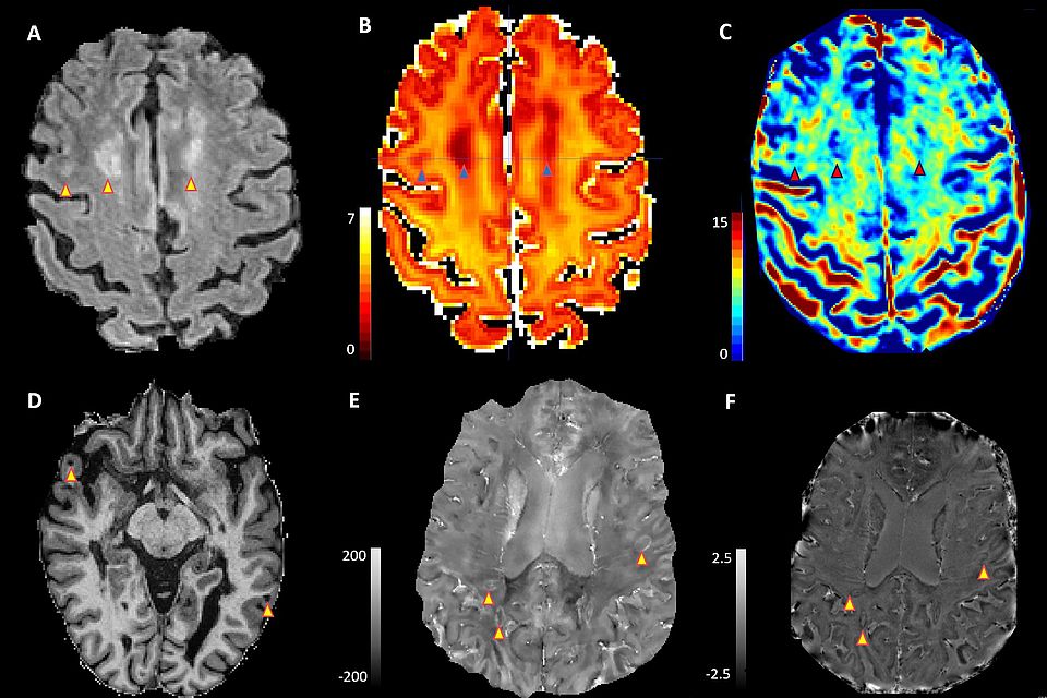 Different MRI sequences in an MS patient: A) Typical presentation of a white matter lesion in routine clinical sequence; special sequences show reduced myelin (B) and axon density (C) in the same MS lesion. Newly developed special sequences for imaging cortical (D) and chronically active (E+F) lesions.
