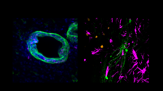 B lymphocytes in the brain during acute inflammation. The left picture shows a blood vessel (green) in the brain, in which B-lymphocytes (pink) can be seen in the vessel wall and in the brain tissue around the vessel. The right picture shows virus infected nerve cells (green), astrocytes (pink) and B-lymphocytes (yellow) in the brain.
